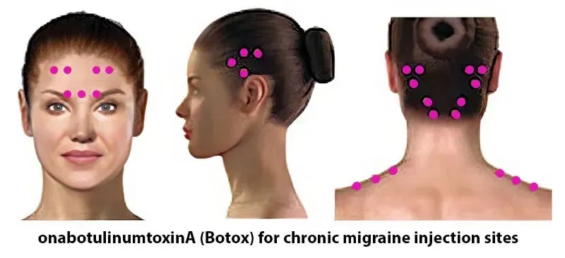 تاثیر تزریق بوتاکس