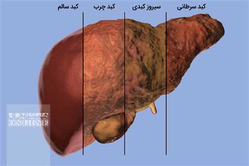 داروی اکساری حاوی رزمتیروم برای درمان بیماران مبتلا به کبد چرب همراه با فیبروز کبدی