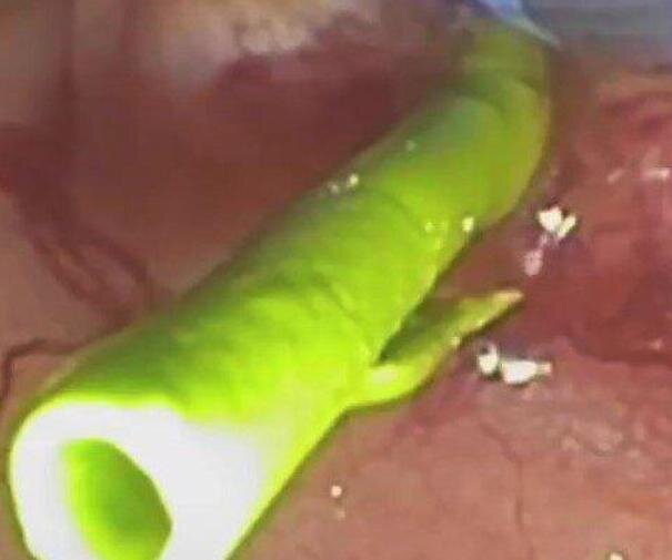 پیوند شگفت‌انگیز آهن و انسولین برای محافظت از لوزالمعده