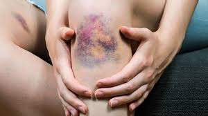 هموفیلی کودکان