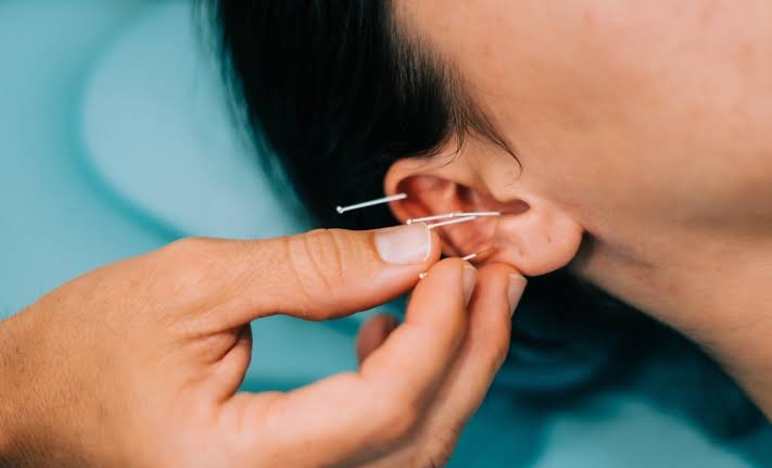 کاهش درد میگرن بدون دارو؛ طب سوزنی گوش