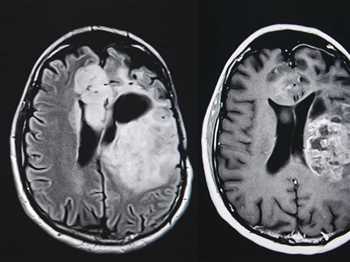 تاثیر ویتامین B3 بر تومور مغزی
