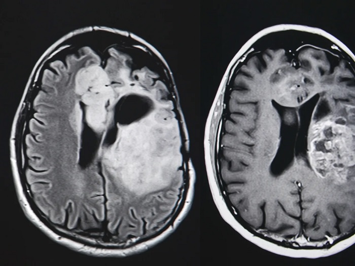 تاثیر ویتامین B3 بر تومور مغزی